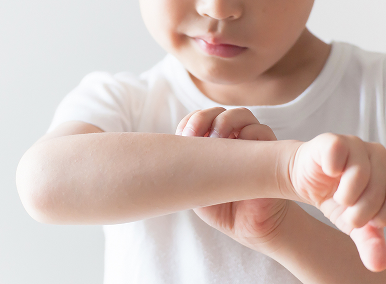 痛みの訴えが強いお子様のイボ治療（モノクロロ酢酸）